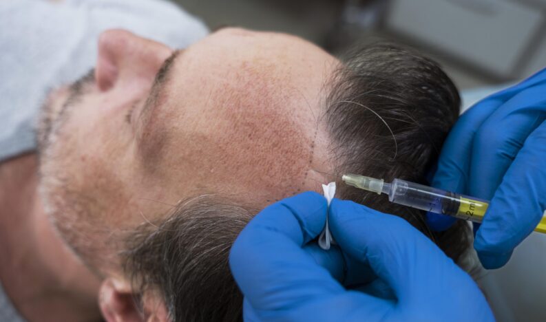 man-getting-hair-loss-treatment