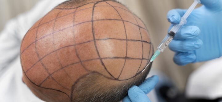 bold-man-going-through-follicular-unit-extraction-process